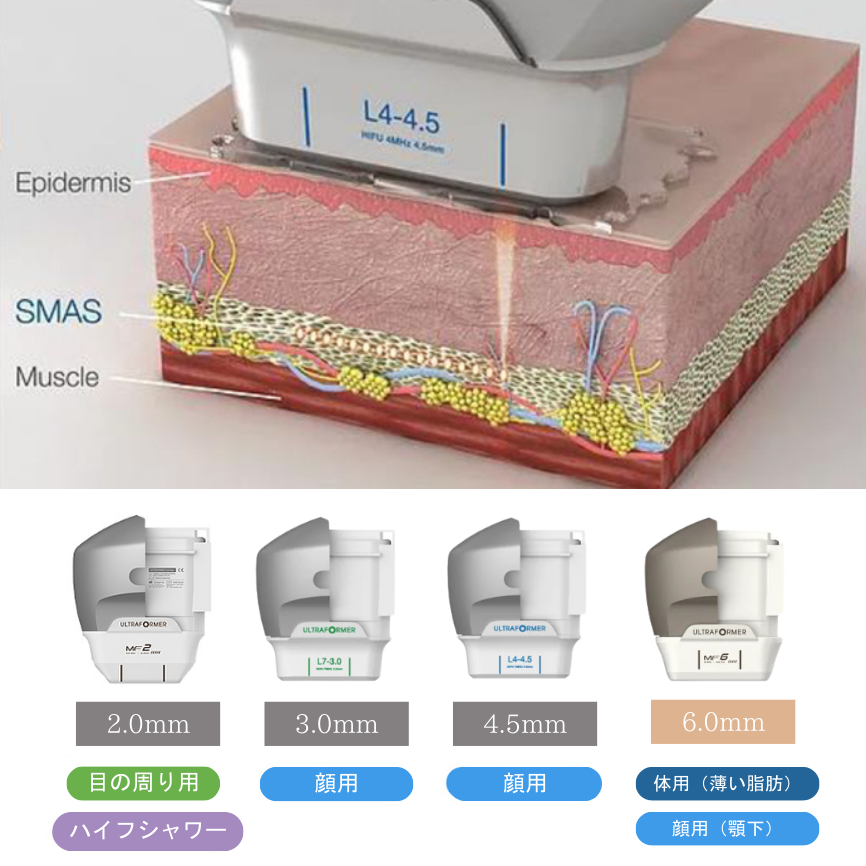 ハイフ（ウルトラフォーマーⅢ）によるたるみ治療の様子