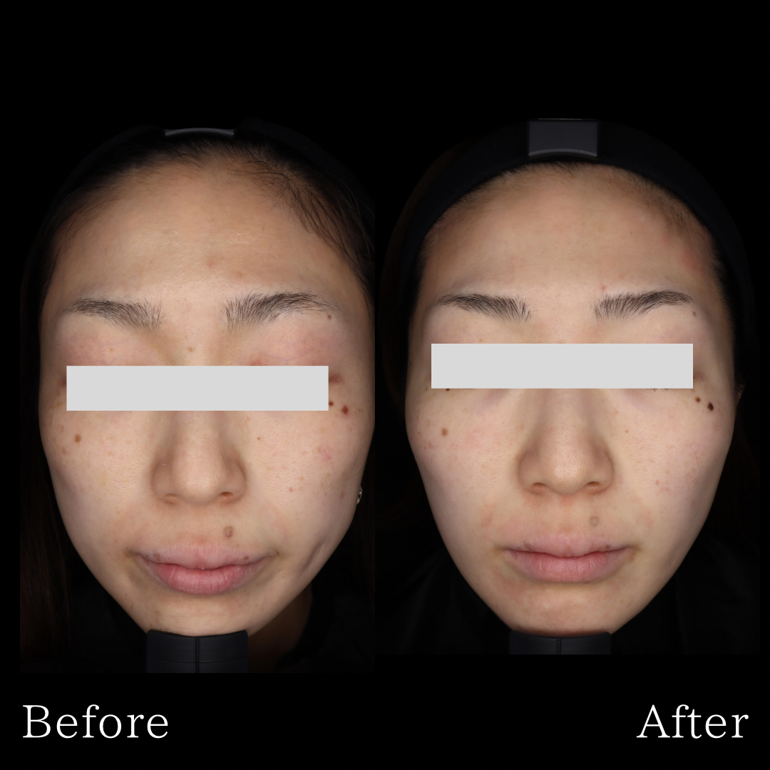 ハイフ（ウルトラフォーマーⅢ） | 症例写真