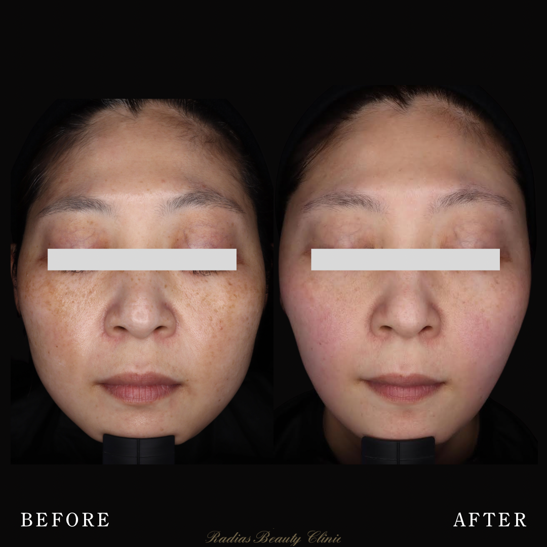 ピコレーザー | 症例写真