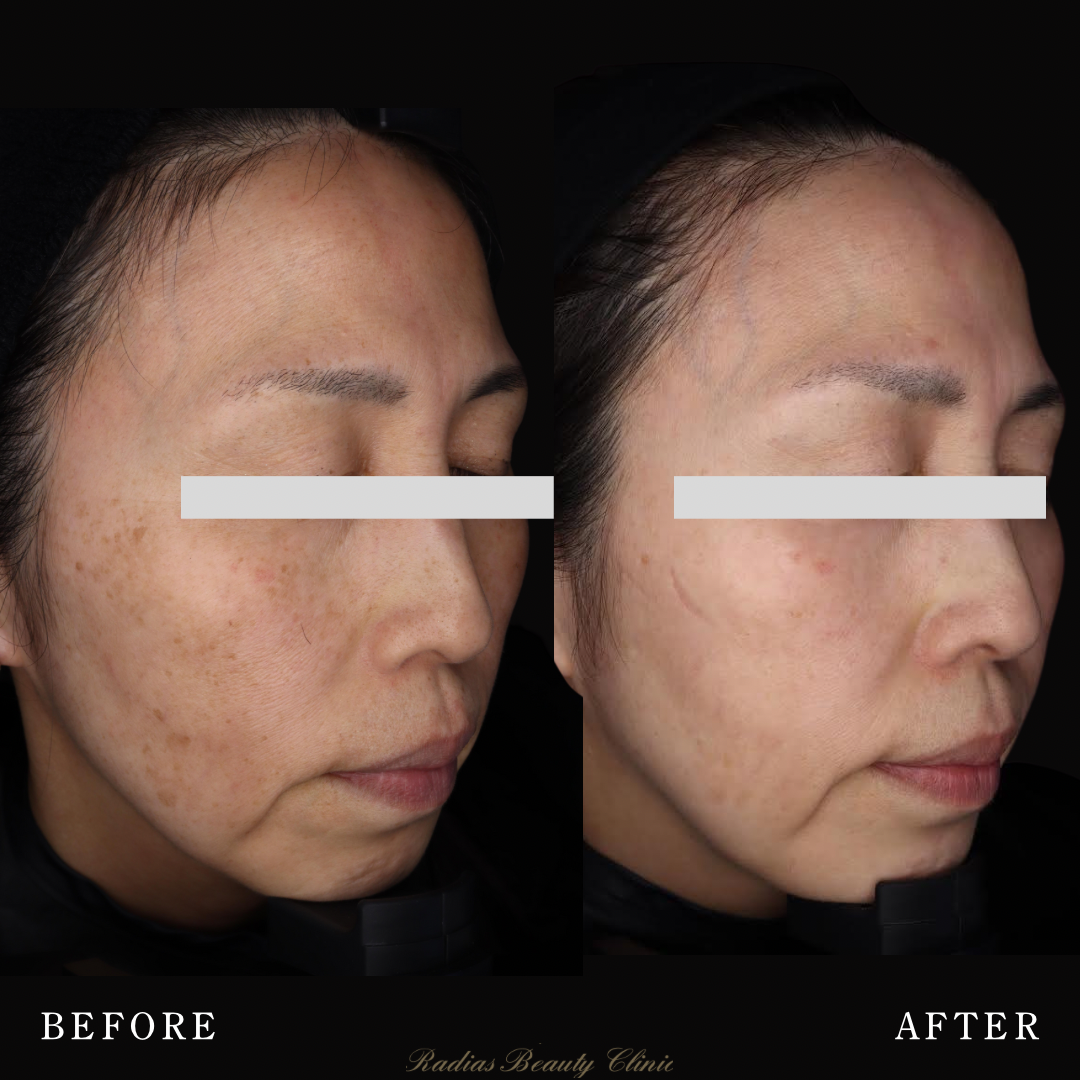 ピコレーザー | 症例写真