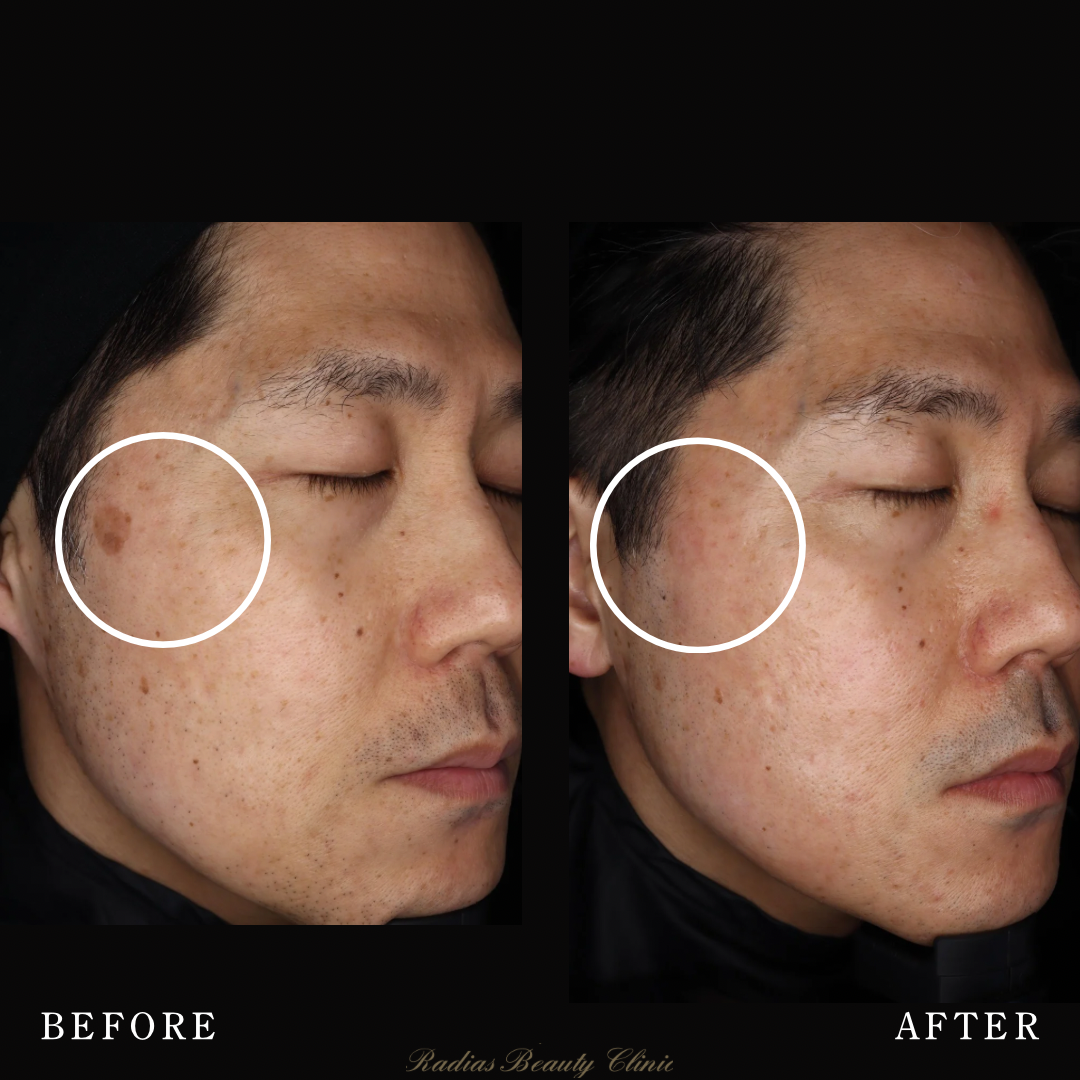 ピコレーザー | 症例写真